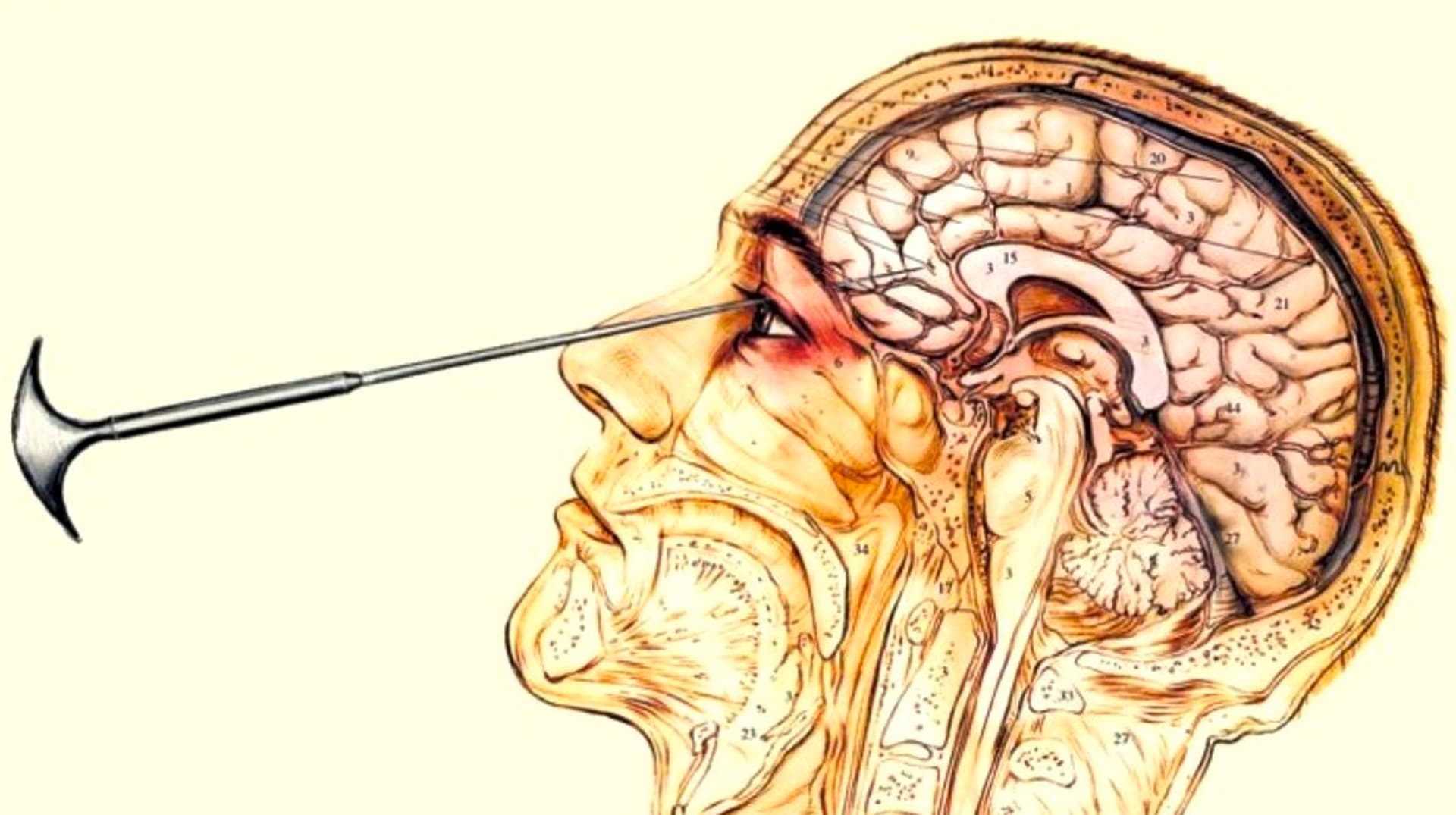 Lobotomy (Slang) meme template - Lobotomy